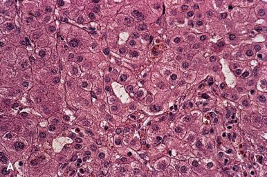Figure 19.43, Cholestatic Liver Cell Rosettes.