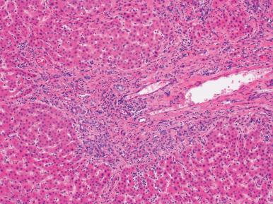 Figure 19.44, Ductular Reaction in Chronic Cholestasis.