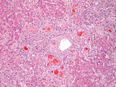 Figure 19.45, Ductular bilirubinostasis featuring markedly dilated ductules filled with bile concrements.