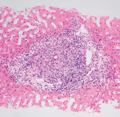 Figure 19.46, A portal tract in primary biliary cirrhosis contains a nodular mixed inflammatory infiltrate consisting of lymphocytes, plasma cells, numerous eosinophils, and histiocytes. There is a damaged bile duct in the center of the portal tract.