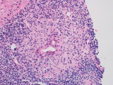 Figure 19.47, Florid Duct Lesion in Primary Biliary Cirrhosis.