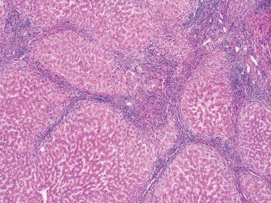 Figure 19.48, Biliary-type cirrhosis in primary biliary cirrhosis, featuring irregular cirrhotic nodules, lymphocytic interface hepatitis, and ductopenia.