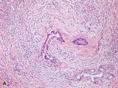 Figure 19.49, A, Primary sclerosing cholangitis showing a damaged bile duct with surrounding edema, concentric fibrosis, and lymphoplasmacytic inflammation. B, Detail of portal tract with moderately dense inflammatory infiltrate (mainly lymphocytes, some eosinophils) and concentric, lamellated, periductal fibrosis (“onion skin” fibrosis) around the interlobular bile duct.