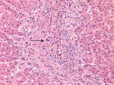 Figure 19.50, Primary sclerosing cholangitis featuring nonspecific ductular reaction, changes of chronic cholestasis, and a markedly atrophic duct (arrow) . Inflammation is minimal.