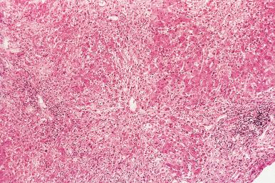 Figure 19.5, Severe Necrotizing Acute Viral Hepatitis B.