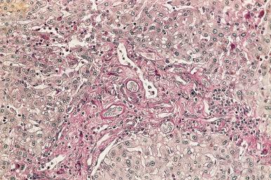 Figure 19.51, Primary Sclerosing Cholangitis.