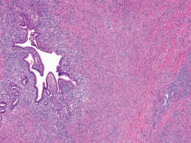 Figure 19.52, IgG4-associated sclerosing cholangitis featuring marked periductal lymphoplasmacytic inflammation and surrounding storiform fibrosis in a large intrahepatic bile duct.