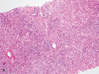 Figure 19.6, Fibrosing Cholestatic Hepatitis C.