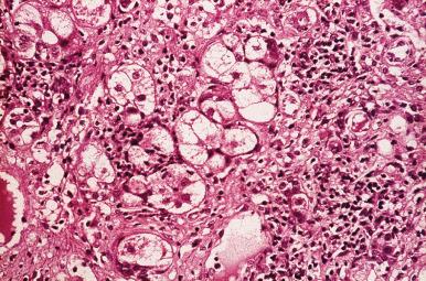 Figure 19.8, Severe Chronic Viral Hepatitis B.