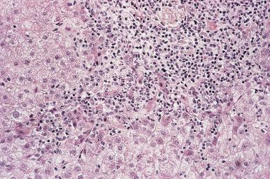 Figure 19.9, Marked interface hepatitis (“piecemeal necrosis”) in chronic viral hepatitis B. Note the inflamed portal tract (upper right) with an irregular interface between the portal periphery and adjacent parenchyma.