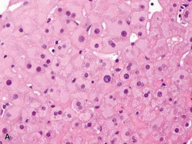 Figure 19.10, A, Ground-glass hepatocytes, characterized by eosinophilic, homogeneous and paler cytoplasm than surrounding normal hepatocytes. B, Note the artifactual cleft between the “ ground-glass” cytoplasm and the hepatocellular cell membrane.