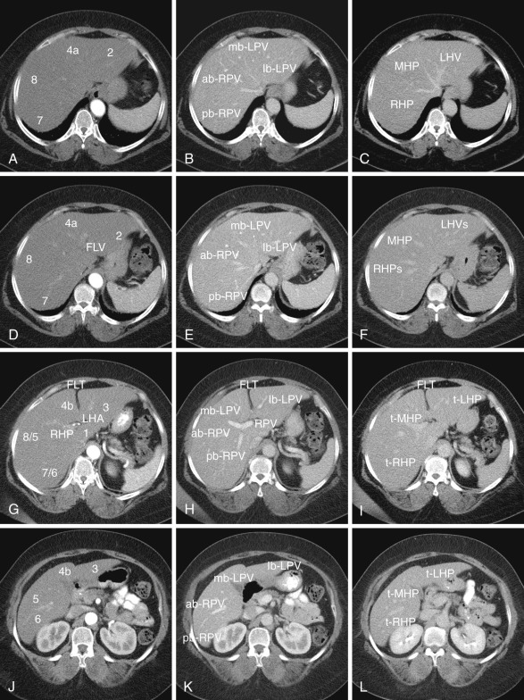 FIG 43-1, Triple-phase contrast-enhanced MDCT imaging during the hepatic arterial phase ( A, D, G, and J ), the portal venous phase ( B, E, H, and K ) and the delayed hepatic phase ( C, F, I, and L ) at different levels in regard to the portal venous plane: upper superior plane ( A to C ), lower superior plane ( D to F ), portal venous plane ( G to I ), and inferior plane ( J to L ). A to C, In the upper superior hepatic plane the hepatocentric venous branches of the right hepatic vein (RHV), middle hepatic vein (MHV), and left hepatic vein (LHV) are clearly seen, differentiating the superior hepatic segments (2, 4a, 8, and 7) that are supplied by the lateral branch (lb-LPV) and medial branch (mb-LPV) of the left portal vein as well as the anterior branch (ab-RPV) and posterior branch (pb-RPV) of the right portal vein, respectively. D to F, The lower superior hepatic plane shows the more intrahepatic segments of right hepatic vein (RHV), middle hepatic vein (MHV), and left hepatic vein (LHV) as well as lateral branch (lb-LPV) and medial branch (mb-LPV) of the left portal vein and anterior branch (ab-RPV) and posterior branch (pb-RPV) of the right portal vein. The fissure for the ligamentum venosum (FLV) separates the upper caudate. G to I, In the portal venous plane the hepatocentric right portal vein (RPV) and left portal vein (LPV) can be seen with their corresponding lateral branch (lb-LPV) and medial branch (mb-LPV), as well as anterior branch (ab-RPV) and posterior branch (pb-RPV), respectively. Hepatocentric left hepatic and right hepatic arteries can be seen. Segment 1, the caudate lobe, is also visible. The terminal left hepatic vein (t-LHP) can bee seen to the left of the fissure of the ligamentum teres (FLT); the terminal terminal middle (t-MHP) and right (t-RHP) are on its right side. J to L, In the inferior hepatic plane the inferior hepatic segments (3, 4b, 6, and 5) and their analogously supplying distal portal venous branches can be found.