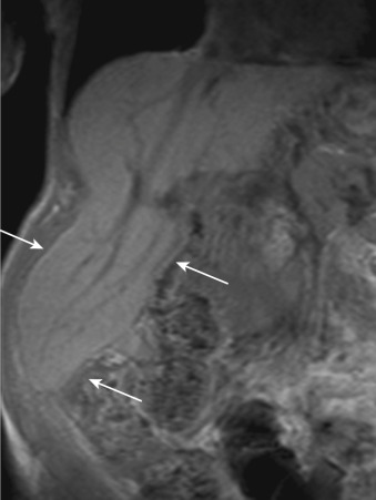 FIG 43-2, Precontrast T1-weighted hepatic MRI in a 77-year-old woman with Riedel's lobe (arrows) resulting from a prominent inferiorly positioned narrow right lobe of the liver that significantly extends the expected confines of the liver.