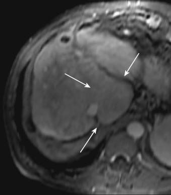 FIG 43-3, T1-weighted contrast-enhanced MRI of a 55-year-old man with hypertrophy and extension of the caudate lobe (arrows), also known as a papillary hepatic process. Note the simple cyst along the fissure for the ligamentum teres (arrowhead).