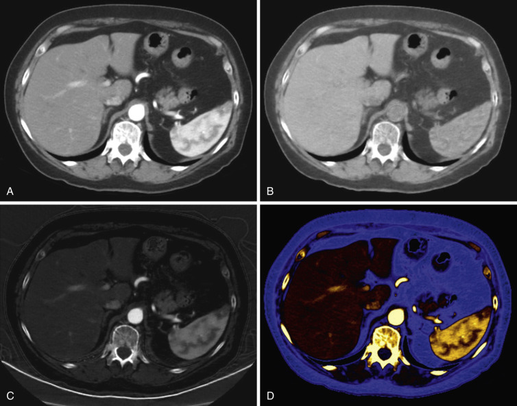 FIG 43-4, Dual-energy MDCT of the liver in a 52-year-old man. Dual-energy MDCT workflow with conventional grayscale data set ( A ), water-density ( B ), iodine-density ( C ) and color-coded iodine overlay map ( D ).