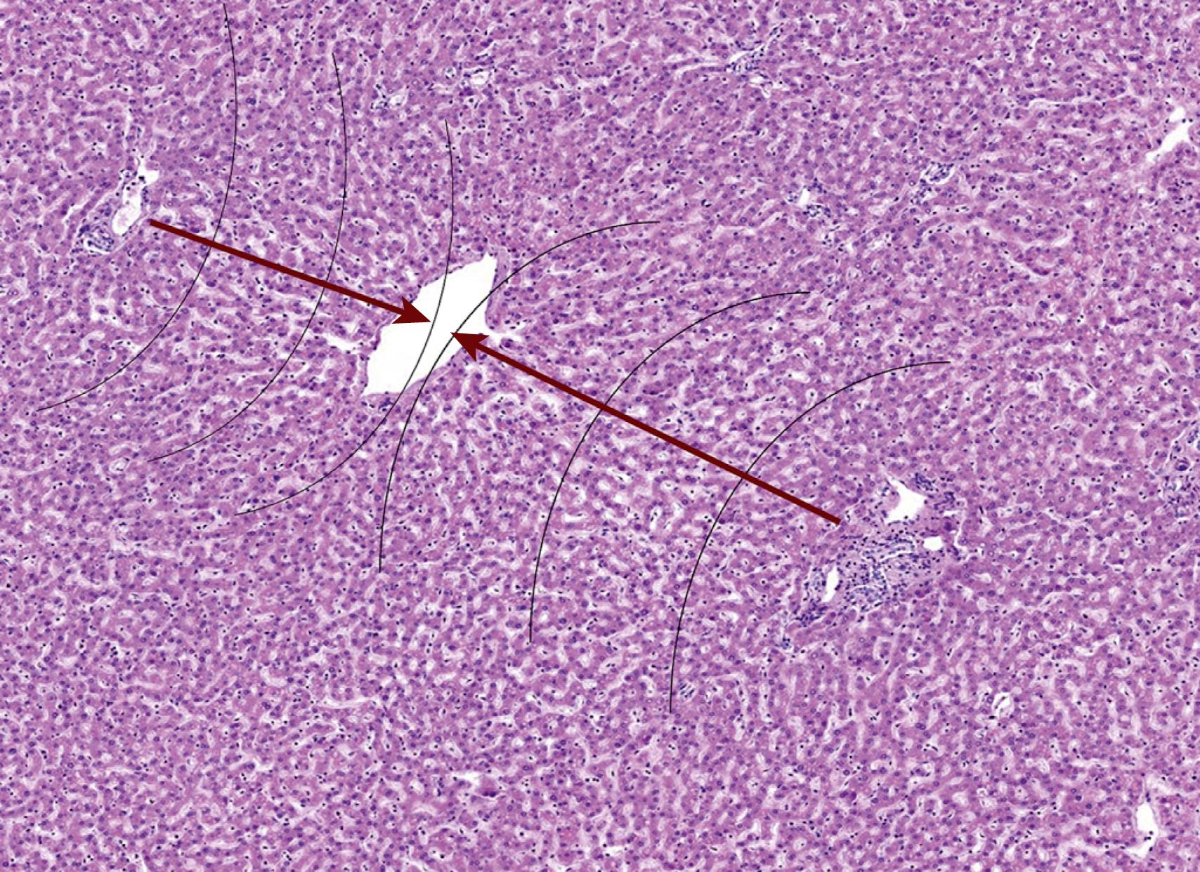 Fig. 66.1, Low power photomicrograph demonstrating the functional zonal architecture (black crescents) and portal to central blood flow (dark red arrows) . Zone 1 hepatocytes are closest to portal tracts and receive the most oxygenated blood.