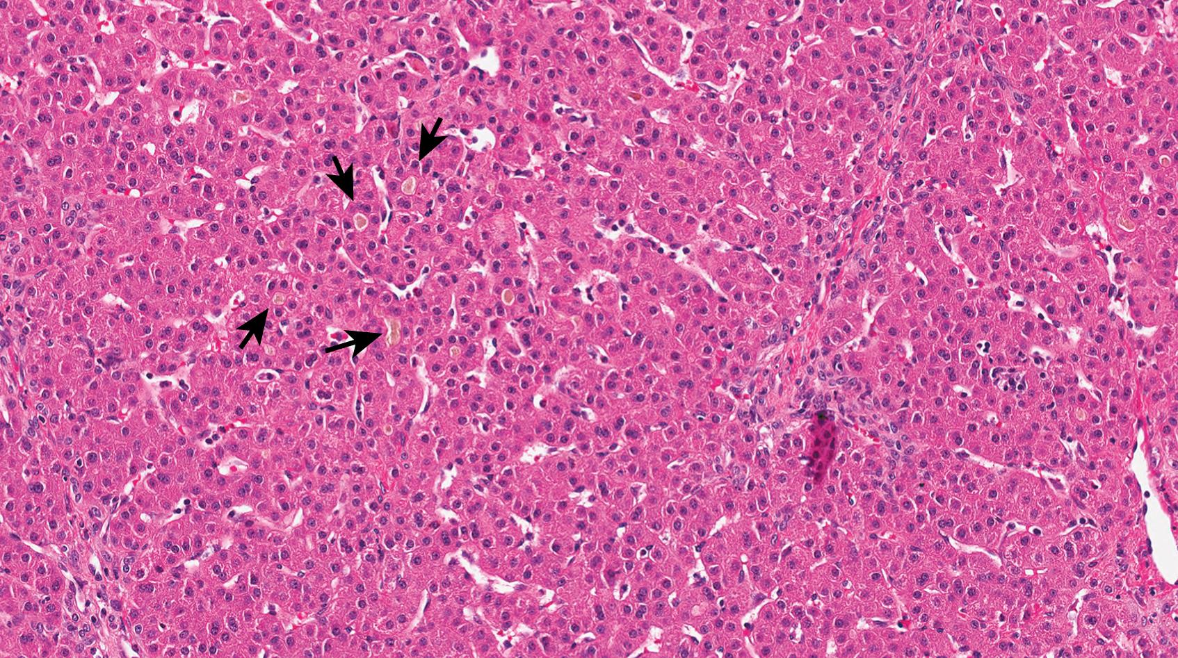 Fig. 66.11, Wedge biopsy from a patient with progressive familial intrahepatic cholestasis 1 ( ATP8B1 disease) reveals canalicular cholestasis (arrows) that is paler than normal bile—compare with Fig. 66.1.