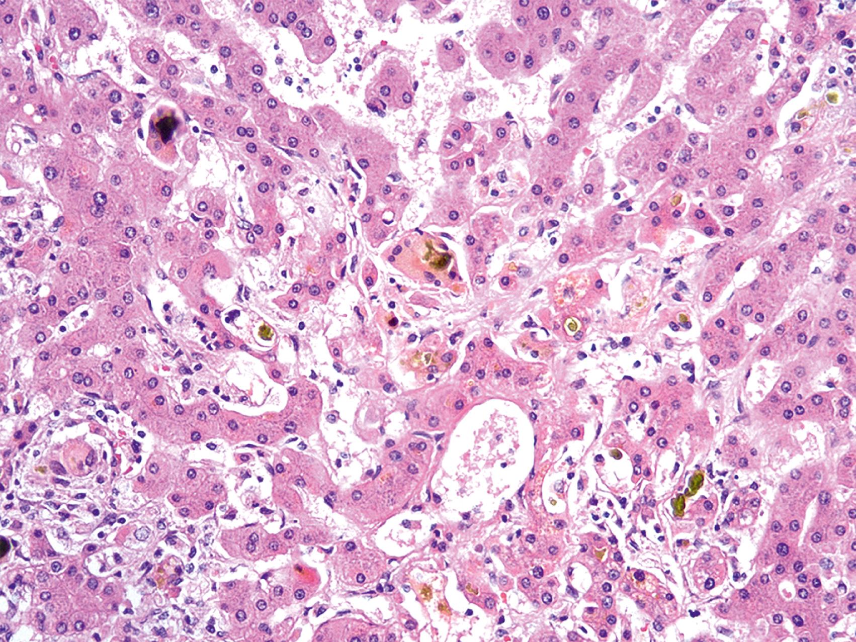 Fig. 66.3, High-magnification view of canalicular cholestasis, characterized by green-black pigment filling the spaces between hepatocytes.