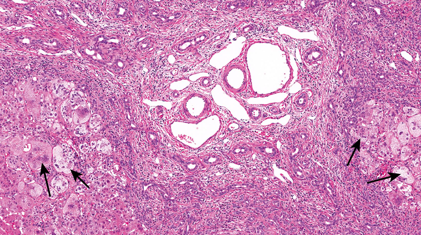 Fig. 66.4, Portal changes in patients with biliary atresia are nonspecific, as any cause of biliary outflow impairment can cause similar changes. The portal tract (center) is minimally inflamed but expanded by fibrosis and edema. There is prominent bile ductular proliferation, particularly at the periphery. Note the impressive giant cell transformation of hepatocytes, which can be a pitfall in the diagnosis of biliary obstruction.