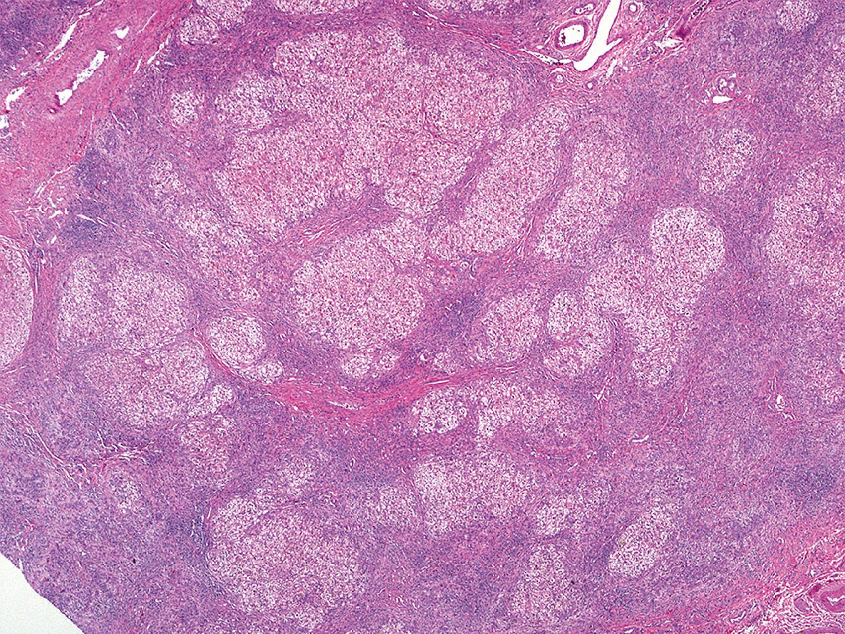 Fig. 66.5, Low power photomicrograph of an explanted liver with biliary-type cirrhosis. The best histologic clue involves the identification of irregular, or “jigsaw puzzle piece,” cirrhotic nodules. Further, the nodules are quite pale-staining, owing to chronic cholestasis-induced changes to the hepatocytes (i.e., cholate stasis).