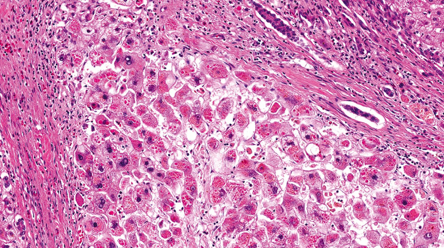 Fig. 66.6, Hematoxylin-and eosin-stained section revealing innumerable eosinophilic inclusions in the cytoplasm of hepatocytes.