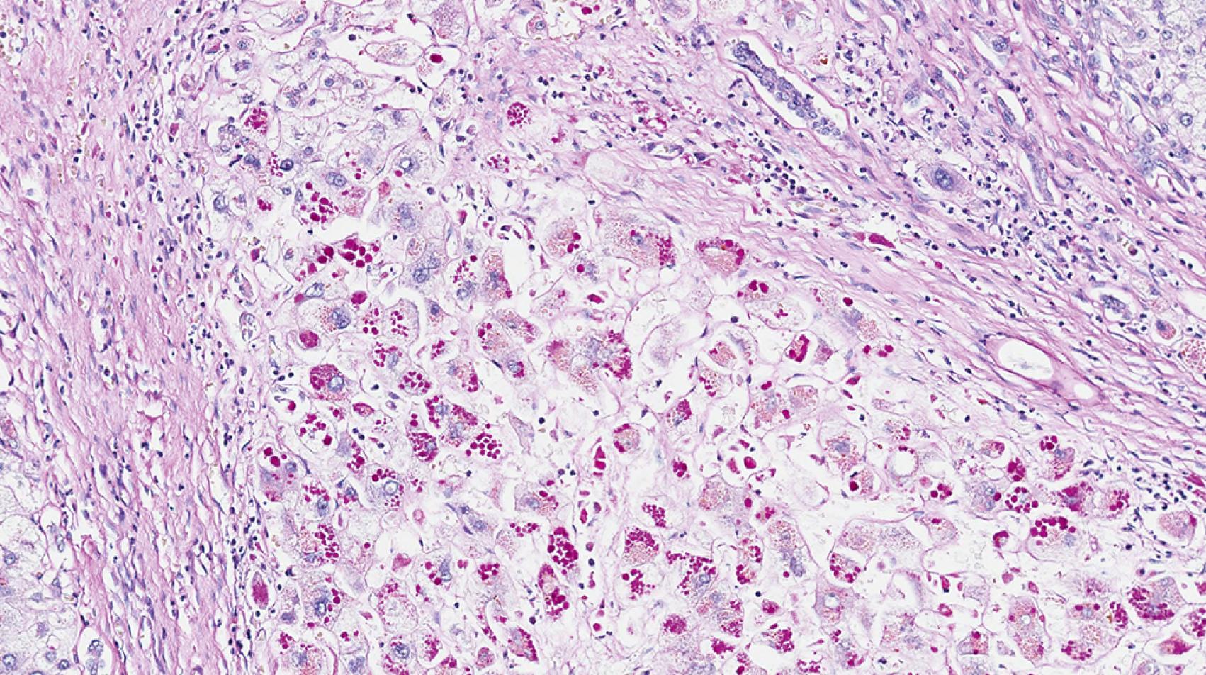 Fig. 66.7, The same area of liver as Fig. 66.6 with periodic acid-Schiff (PAS) staining after diastase digestion. The cytoplasmic inclusions are PAS-positive and diastase-resistant, consistent with alpha-1 antitrypsin inclusions.