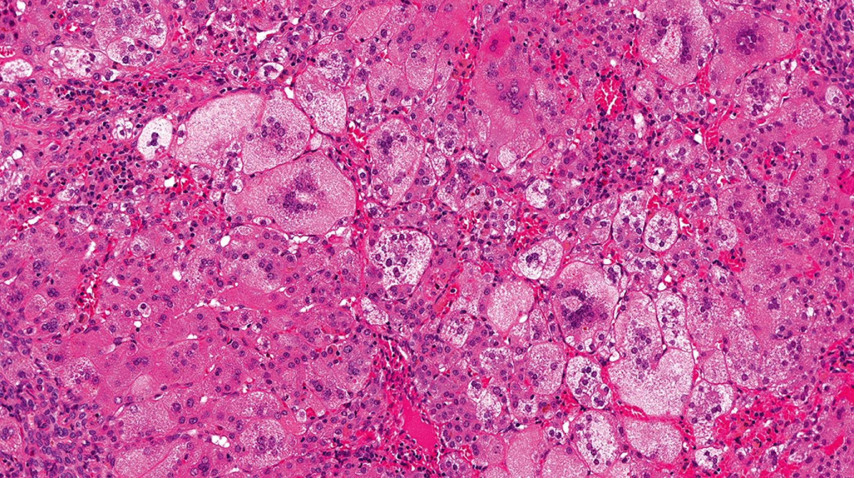 Fig. 66.8, These giant cell hepatocytes are massively enlarged and contain numerous nuclei in each cell.