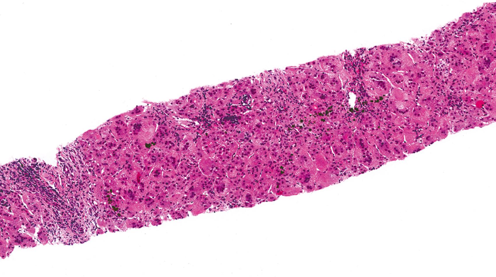 Fig. 66.9, This biopsy specimen was taken from a patient with idiopathic form of neonatal hepatitis. The portal tracts and lobules contain mild chronic inflammation and there are innumerable giant cell hepatocytes. The portal tracts, importantly, lack features of extrahepatic biliary obstruction. These histologic features are not specific, however.