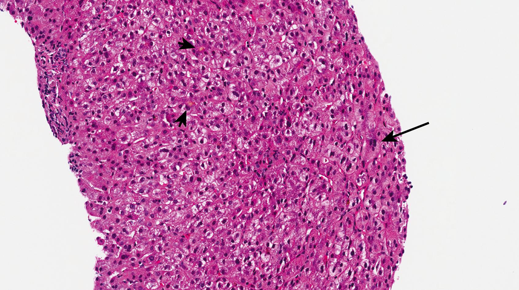 Fig. 66.10, This biopsy from a patient with progressive familial intrahepatic cholestasis 2 ( ABCB11 disease) reveals canalicular cholestasis (short arrows) as well as scattered giant cell hepatocytes and mild lobular disarray (i.e., cholestatic hepatitis).