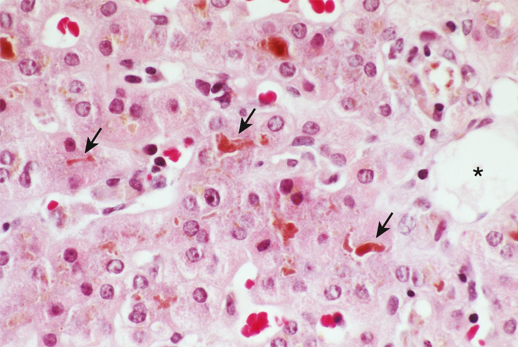 FIGURE 54.2, Liver biopsy specimen from a 19-year-old woman with benign, recurrent, intrahepatic cholestasis who had jaundice early in the second trimester. High-power view of hepatic parenchyma in the vicinity of a central vein (asterisk) shows moderate cholestasis with prominent canalicular bile plugs (arrows). A minimal mononuclear infiltrate is identified in the portal tracts, and occasional acidophilic bodies can be seen (not shown).