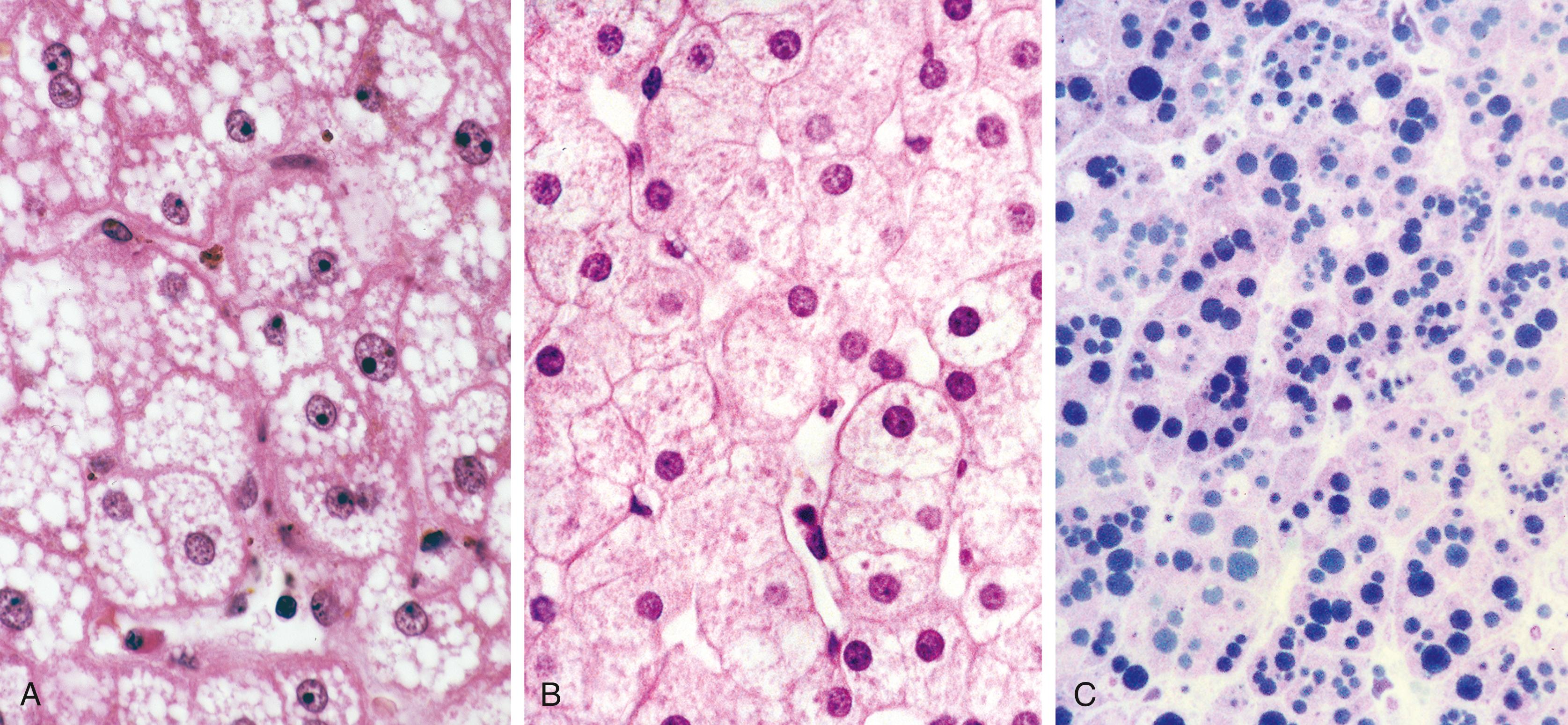 FIGURE 54.3, A, Microvesicular steatosis can be identified by numerous, optically clear vacuoles on routine hematoxylin and eosin (H&E) staining, as shown in this liver biopsy specimen from a 32-year-old woman at 34 weeks’ gestation who had mildly increased levels of aminotransferases and a “giant fatty liver” seen on ultrasonography. B, Microvesicular steatosis in metabolic fatty liver disease may not always be apparent on routine H&E staining, as demonstrated in this biopsy specimen from a patient with liver failure and suspected long-chain 3-hydroxyacyl-CoA dehydrogenase deficiency. C, Toluidine blue–stained plastic sections of an adjacent piece of the biopsy specimen shown in B demonstrates numerous hepatocellular fat droplets.