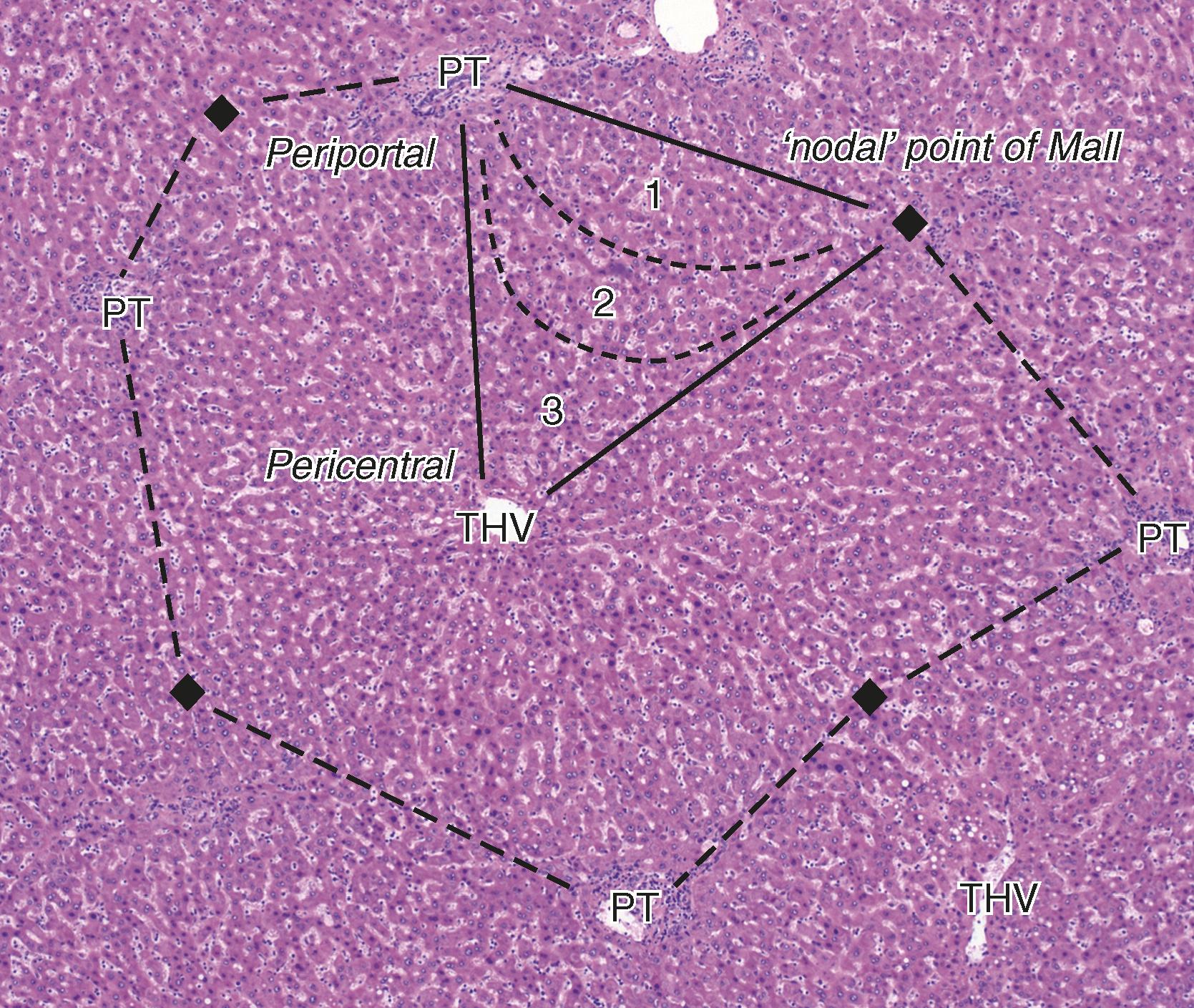 FIGURE 44.1, The normal liver parenchyma, showing portal tracts (PT) and terminal hepatic vein (THV). The concept of the lobule places the THV (“central vein”) at the center of an approximately hexagonal lobule; in this image PT are at four of the eight apices of an octagonal lobule, with the watershed areas between portal tracts (the “nodal point of Mall,” black diamond ) occupying four of those apices. The concept of the acinus places a PT and the watershed area ( black diamond ) at the base of an isosceles triangle, with the THV at the apex of the triangle. Blood exiting the penetrating portal venules travels along a broad curvilinear front through zones 1, 2, and 3 of the acinus; note that zone 3 extends partially toward portal tracts. This image of a normal liver makes clear that the geometry of the lobule and acinus is variable.