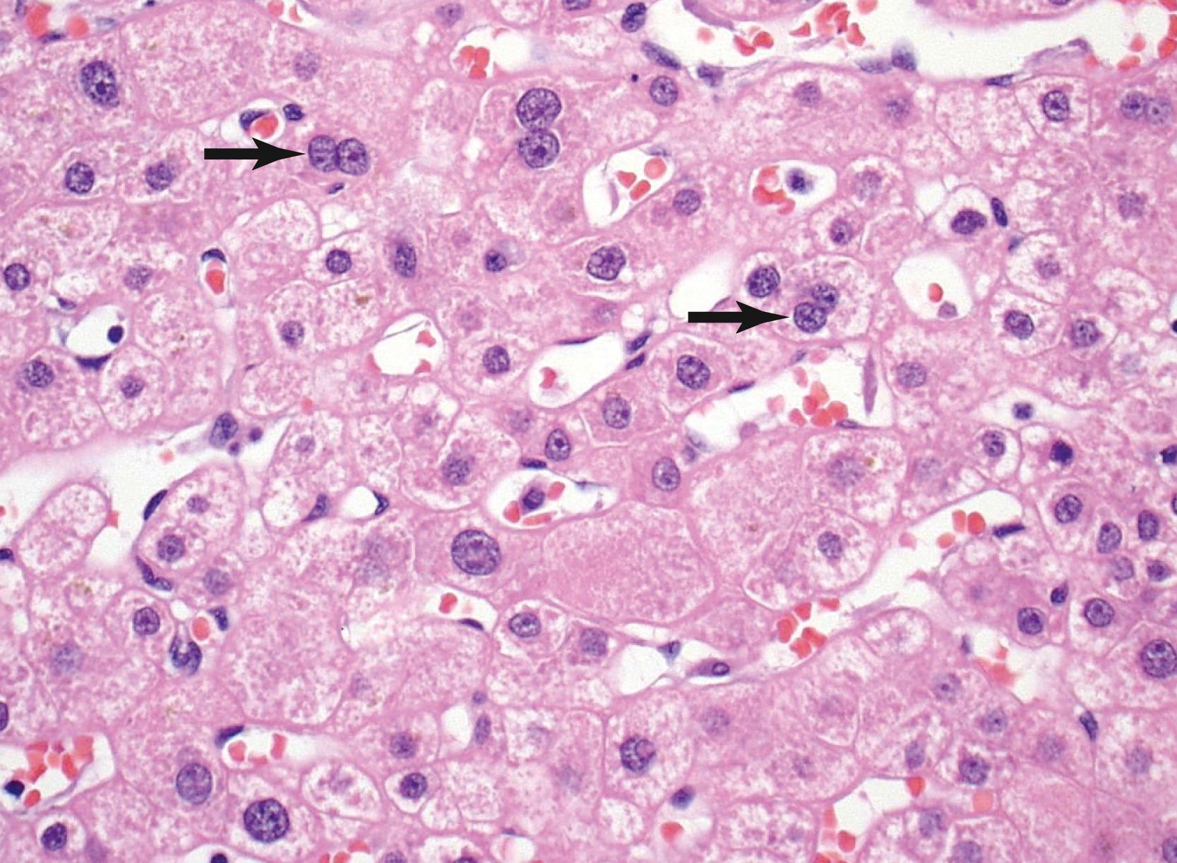 FIGURE 44.2, Liver biopsy from an older individual shows significant polyploidy of hepatocyte nuclei and binucleate forms (arrows) .