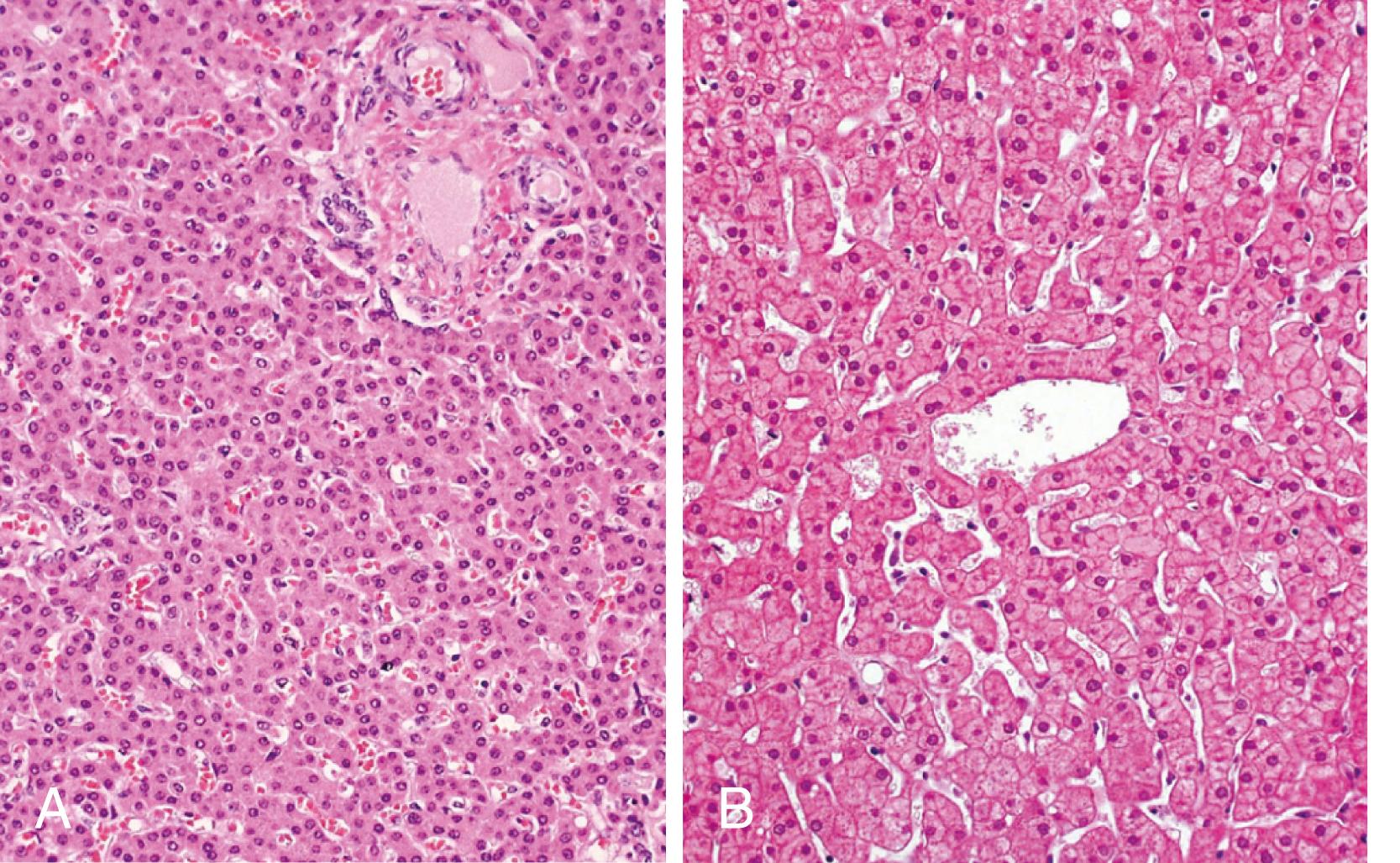 FIGURE 44.3, Comparison of liver parenchyma of a child (A) and an adult (B). In children, the hepatocytes are arranged less regularly, without a distinct radial arrangement, and in two-cell-thick plates. In adults, the hepatocytes are normally one cell thick and show a more regular radial arrangement around the terminal hepatic venule.