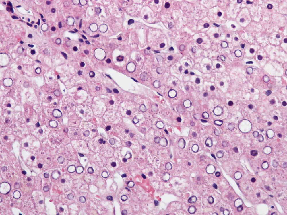 FIGURE 44.5, Glycogen accumulation in hepatocyte nuclei results in a clear, empty appearance.