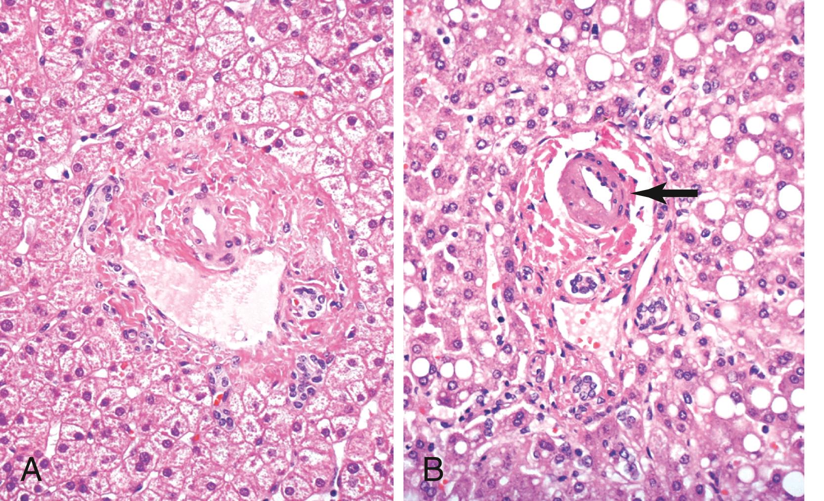 FIGURE 44.7, In older individuals, the portal tracts may contain dense collagen (A), and the hepatic artery may have a thickened wall (B , arrow ).