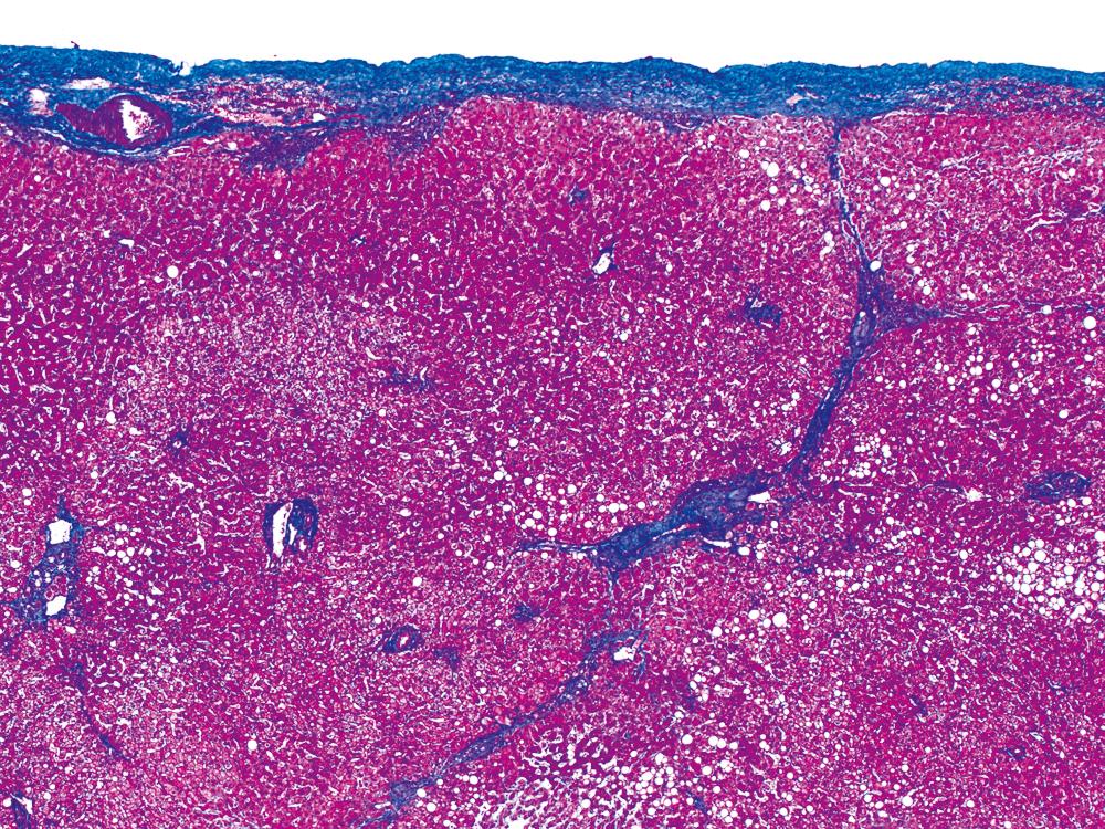 FIGURE 44.8, In the subcapsular liver parenchyma, the mature fibrous framework extends from the capsule (Masson trichrome stain).