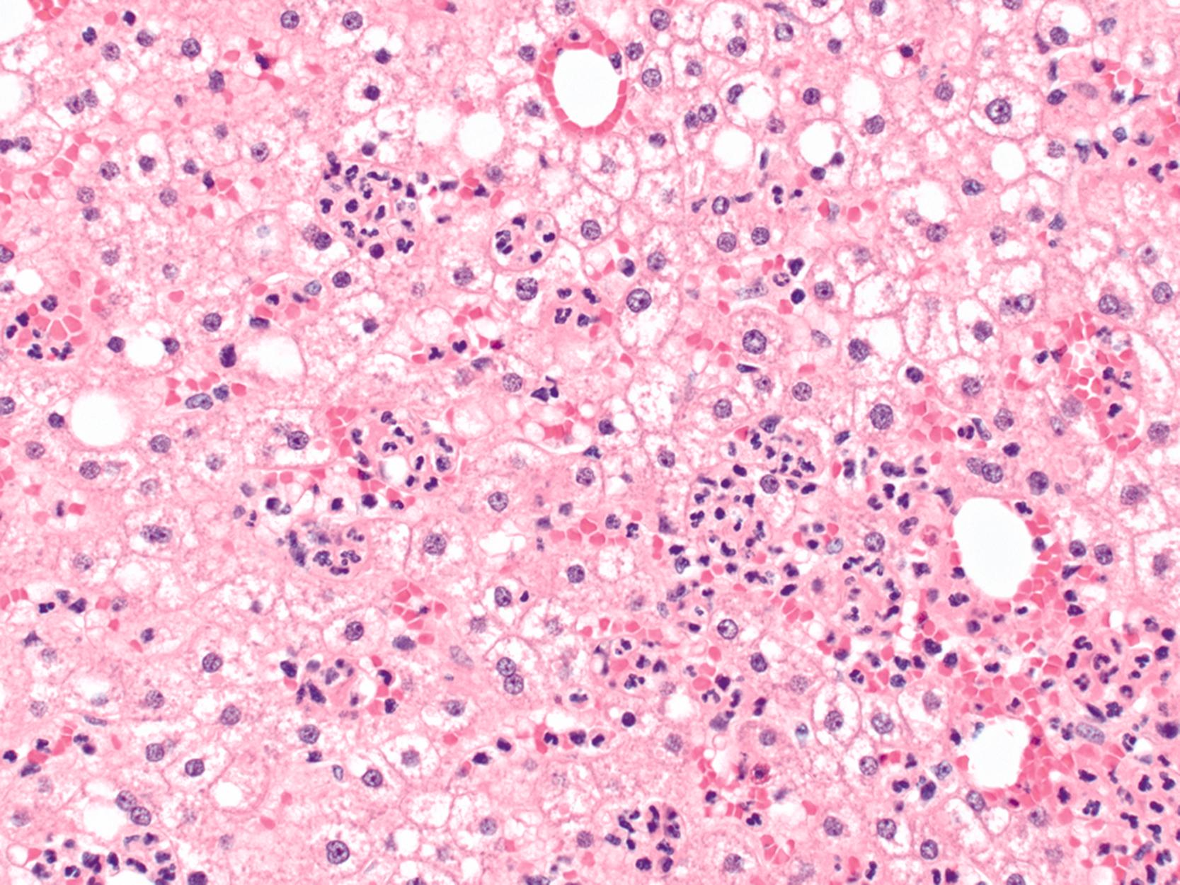 FIGURE 44.9, In intraoperative liver biopsy specimens obtained after a long procedure, clusters of neutrophils may be present (known as surgical hepatitis ).