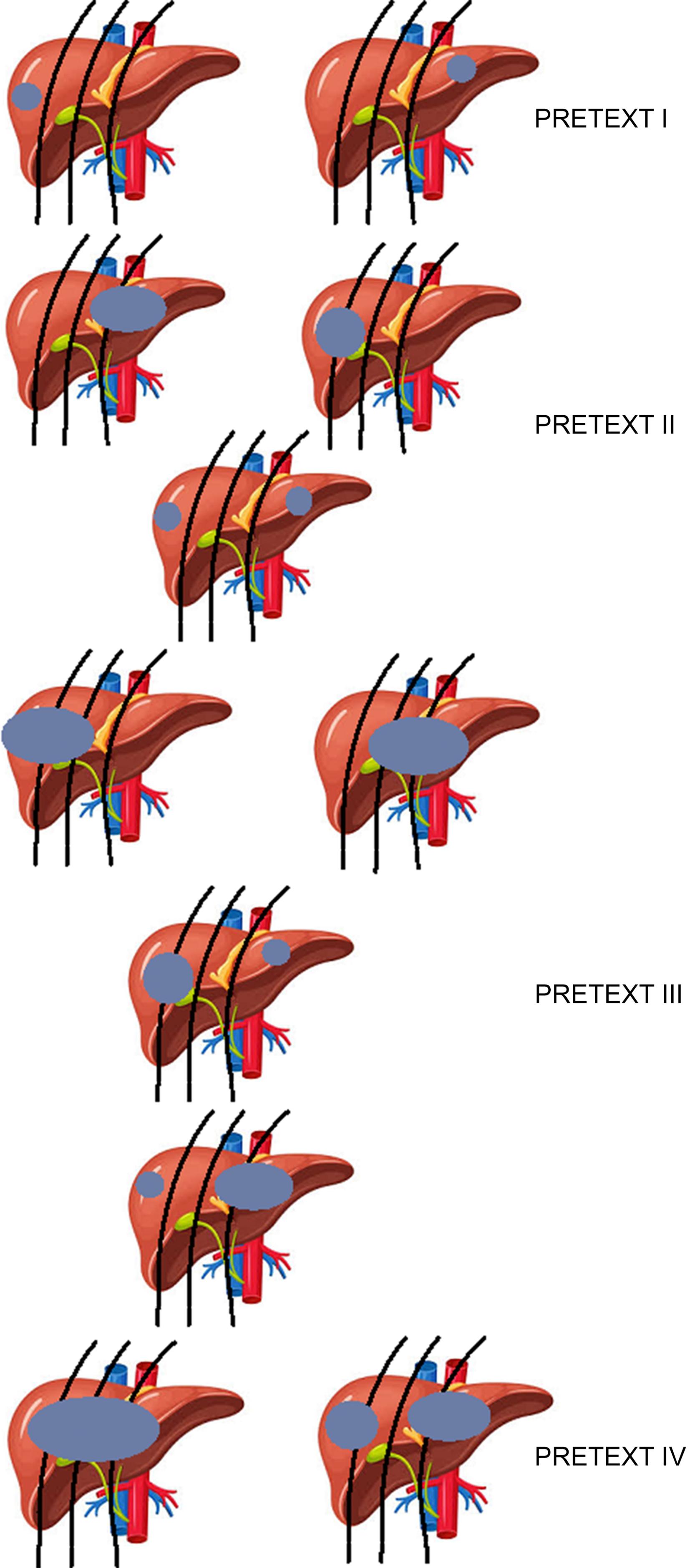 Fig. 38.1, The presence of tumor (represented by gray shaded area) in any of the four sectors of the liver defines the PRETEXT (pretreatment extent of disease) classification for hepatoblastoma. PRETEXT 1 = tumor affecting only one sector; PRETEXT 2 = tumor affecting two sectors; PREXTET 3 = tumor affecting any three sectors; PRETEXT 4 = tumor present in all four sectors. For further details, see Trobaugh-Lotrario et al 16 and Strasberg and Phillips. 19