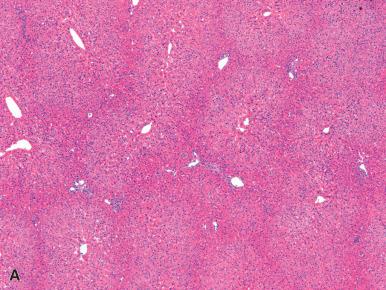 Figure 20.1, A, Nodular regenerative hyperplasia features diffuse nodular transformation without fibrous septa. B, Reticulin stain highlights the nodularity, with intervening areas of atrophic parenchyma.