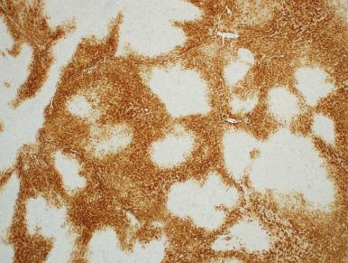 Figure 20.4, Map-like pattern of immunoreactivity with glutamine synthetase in focal nodular hyperplasia.