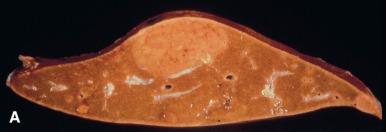 Figure 20.5, A, Well-demarcated hepatocellular adenoma but without a well-defined capsule.