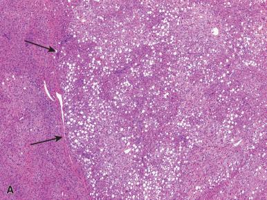 Figure 20.6, A, Diffuse steatosis characterizes adenomas with HNF1α mutations. Note the transition between adenoma and nonneoplastic liver (arrows) . B, Adenomas with CTNNB1 mutations show nuclear immunoreactivity (arrows) with β-catenin and lack fat and inflammatory features as is this case (C) . D and E, Inflammatory (telangiectatic) adenomas feature telangiectatic sinusoidal spaces and marked inflammation.