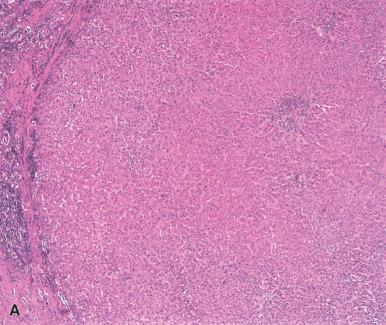 Figure 20.7, A, Regenerative nodule within a cirrhotic liver. B, The reticulin framework is intact, and there is a portal tract within the nodule (arrow) .