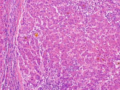 Figure 20.8, High-grade dysplastic nodule showing focal thickening of cell paltes, bile, and focal acinar architecture. Reticulin stain was intact.