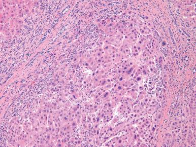 Figure 20.9, Large cell change within a cirrhotic liver, featuring nuclear and cytoplasmic enlargement, nuclear pleomorphism and hyperchromasia, and multinucleated hepatocytes.