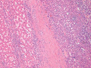 Figure 20.10, Small cell change, indicated by increased nuclear density, is seen in the right half of the picture; cirrhotic liver with hepatocytes of normal size is seen on the left.