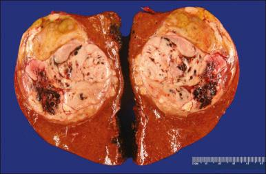 Figure 77.1, A hepatocellular carcinoma forming a well-circumscribed mass and exhibiting a variegated appearance on cut surface. Note the presence of small nodular extensions of the tumor into the adjacent liver parenchyma.