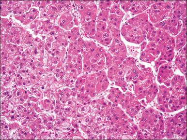 Figure 77.2, A photomicrograph of a hepatocellular carcinoma showing cords and nests of tumor cells with cellular features reminiscent of features seen in normal hepatocytes.