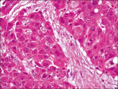 Figure 77.3, A photomicrograph of a fibrolamellar hepatocellular carcinoma showing dense bands of lamellar fibrous tissue separating the polygonal tumor cells with eosinophilic cytoplasm and large nuclei with prominent nucleoli.